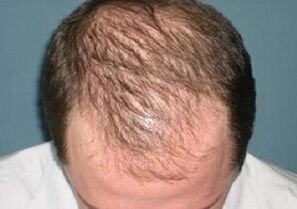 przyczyny wypadania włosów