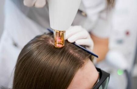 Laseroterapia łysienia androgenowego